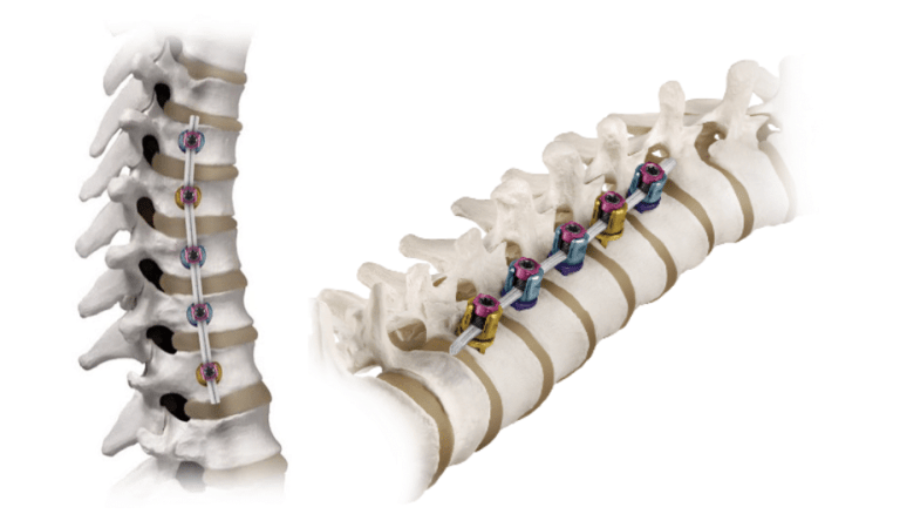 Scoliosis surgery Centro Médico Teknon